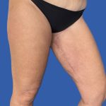 Thigh Lift Before & After Patient #5063