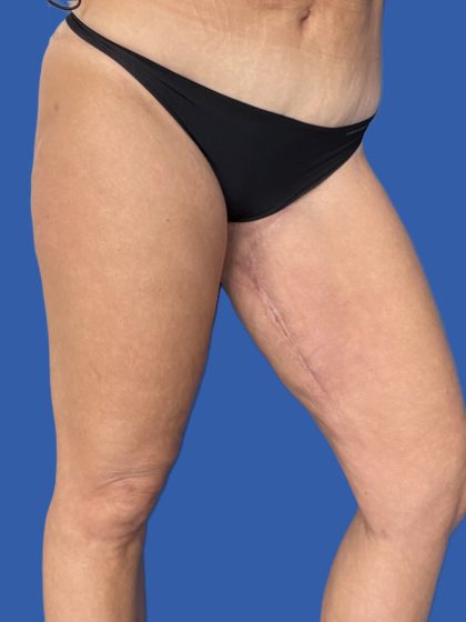 Thigh Lift Before & After Patient #5063