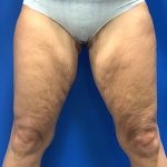 Thigh Lift Before & After Patient #5063