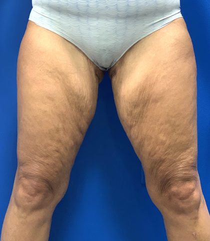 Thigh Lift Before & After Patient #5063