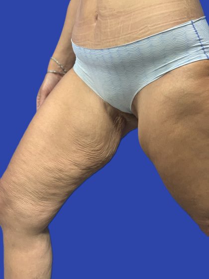 Thigh Lift Before & After Patient #5063