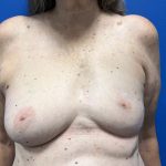 Poland Syndrome Before & After Patient #5089