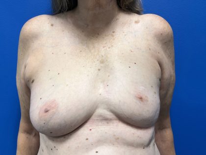 Poland Syndrome Before & After Patient #5089