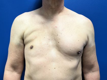 Poland Syndrome Before & After Patient #5096