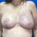 Poland Syndrome Before & After Patient #5089