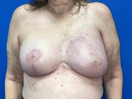 Poland Syndrome Before & After Patient #5089