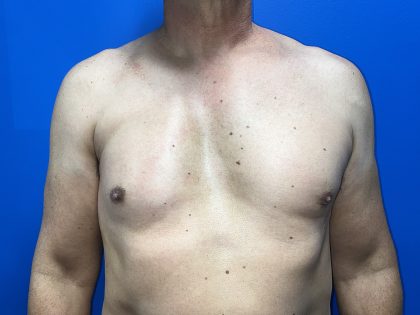 Poland Syndrome Before & After Patient #5096