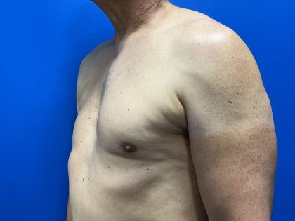 Poland Syndrome Before & After Patient #5096