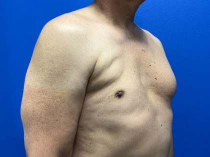 Poland Syndrome Before & After Patient #5096