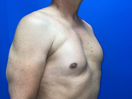 Poland Syndrome Before & After Patient #5096