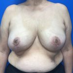 Breast Explant Before & After Patient #5121