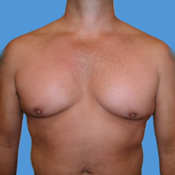 Gynecomastia Before & After Patient #5151