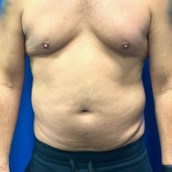 Liposuction Before & After Patient #5144