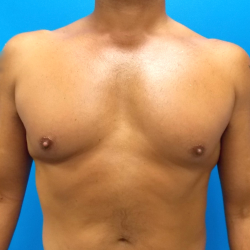 Gynecomastia Before & After Patient #5151