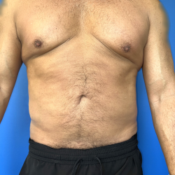 Liposuction Before & After Patient #5144