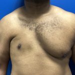 Poland Syndrome Before & After Patient #5199