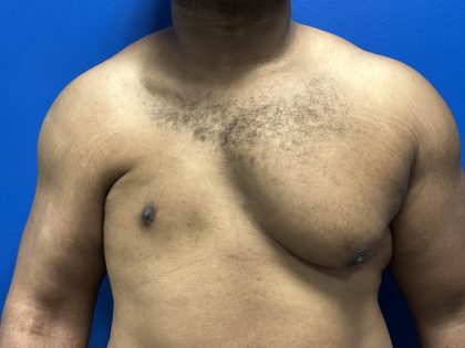 Poland Syndrome Before & After Patient #5199