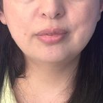 Submental Liposuction Before & After Patient #5192