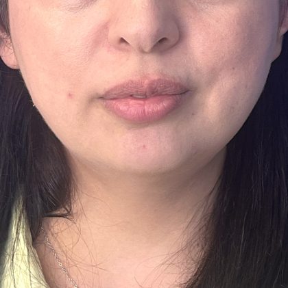 Submental Liposuction Before & After Patient #5192
