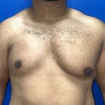 Poland Syndrome Before & After Patient #5199
