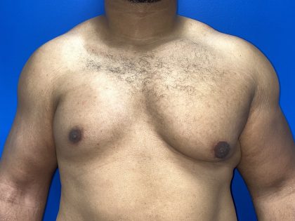 Poland Syndrome Before & After Patient #5199