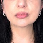 Submental Liposuction Before & After Patient #5192