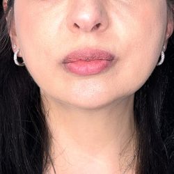 Submental Liposuction Before & After Patient #5192