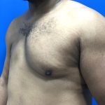 Poland Syndrome Before & After Patient #5199