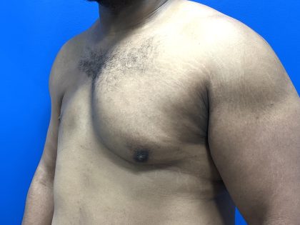 Poland Syndrome Before & After Patient #5199