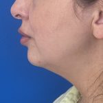 Submental Liposuction Before & After Patient #5192