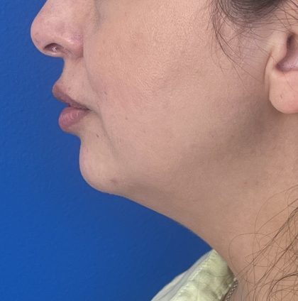 Submental Liposuction Before & After Patient #5192