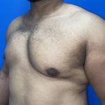 Poland Syndrome Before & After Patient #5199