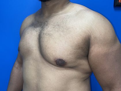 Poland Syndrome Before & After Patient #5199