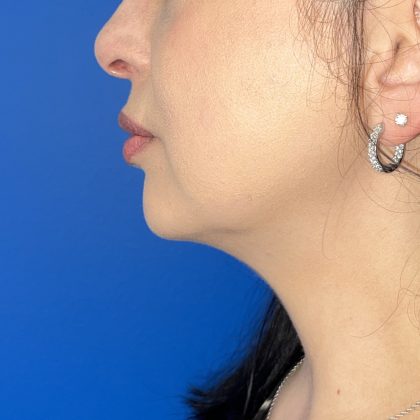 Submental Liposuction Before & After Patient #5192