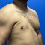 Poland Syndrome Before & After Patient #5199