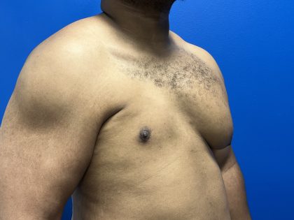 Poland Syndrome Before & After Patient #5199