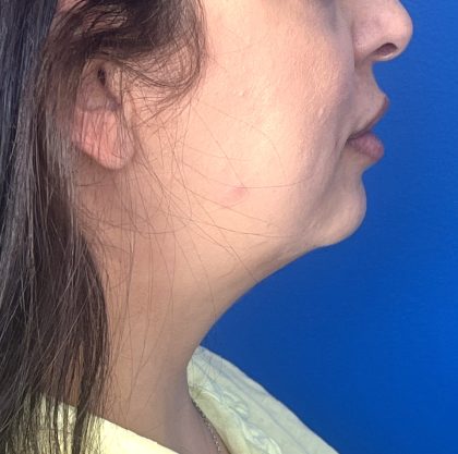 Submental Liposuction Before & After Patient #5192