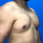 Poland Syndrome Before & After Patient #5199