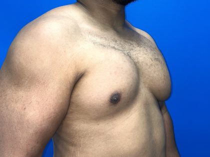 Poland Syndrome Before & After Patient #5199