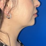 Submental Liposuction Before & After Patient #5192