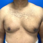 Poland Syndrome Before & After Patient #5199