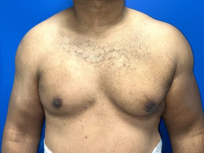 Poland Syndrome Before & After Patient #5199