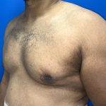 Poland Syndrome Before & After Patient #5199