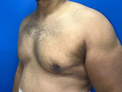 Poland Syndrome Before & After Patient #5199