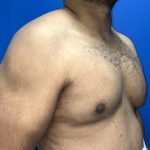 Poland Syndrome Before & After Patient #5199