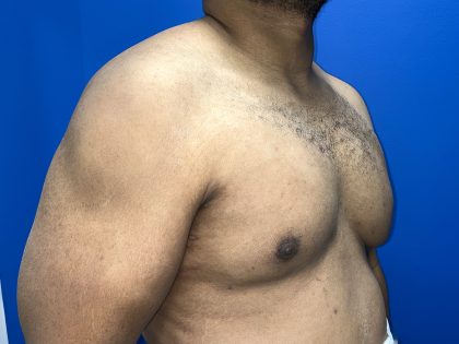 Poland Syndrome Before & After Patient #5199