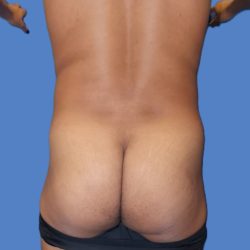 Body Contouring Before & After Patient #5218