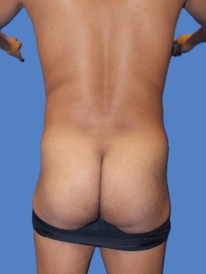 Body Contouring Before & After Patient #5218