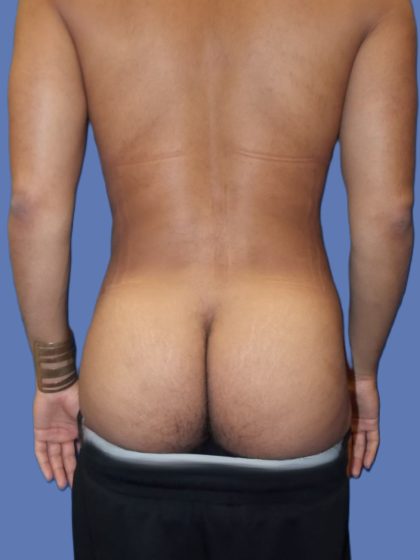 Body Contouring Before & After Patient #5218