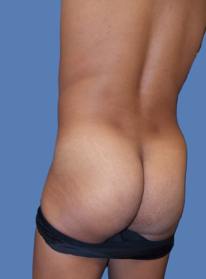 Body Contouring Before & After Patient #5218